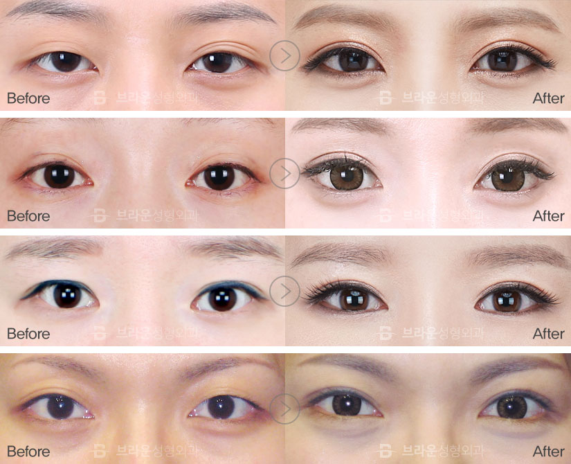 natural double eyelid