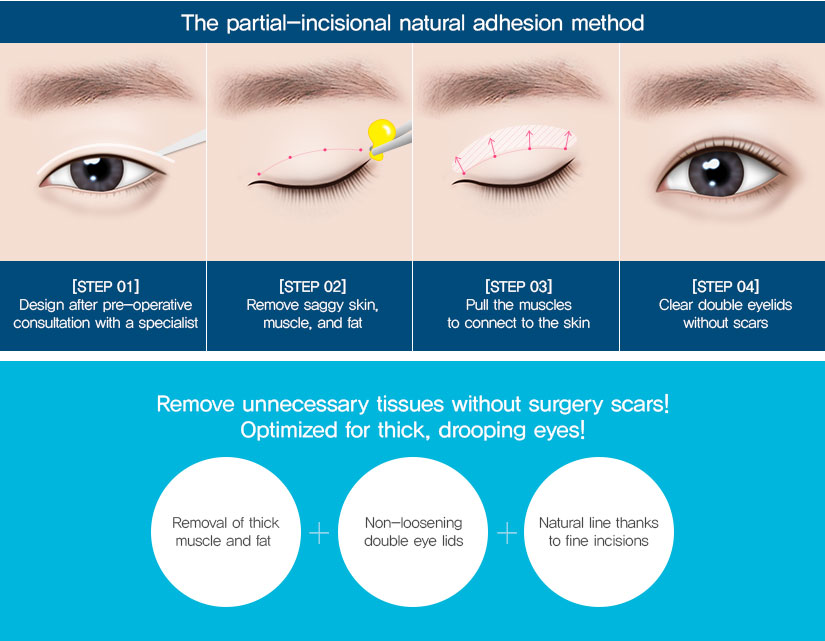 partial incision eyelid surgery