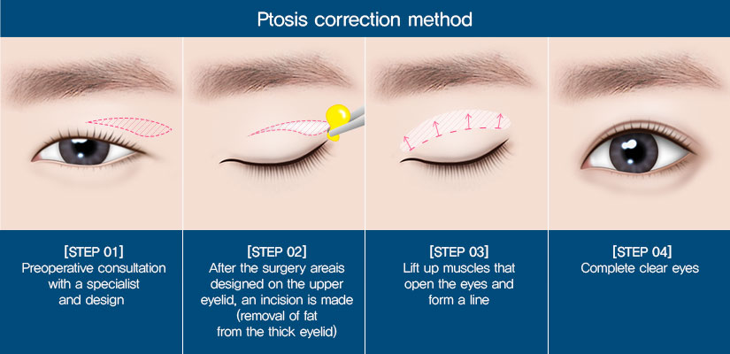 Ptosis correction surgery｜Braun Plastic Surgery