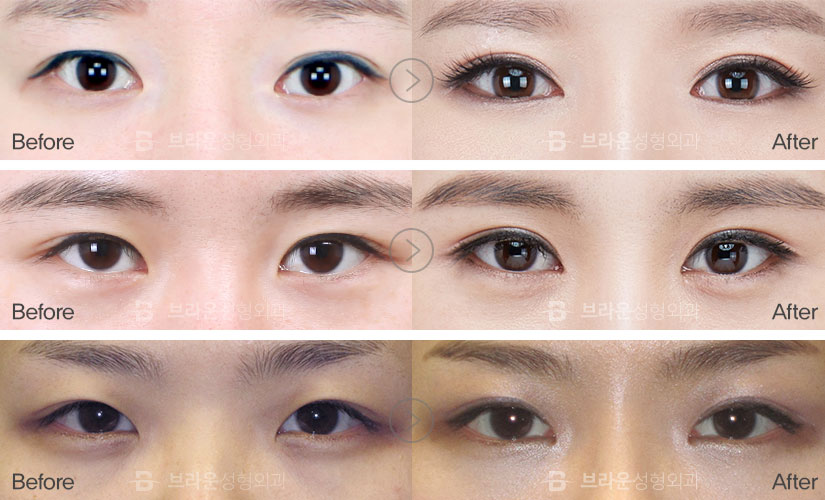 failed double eyelid surgery