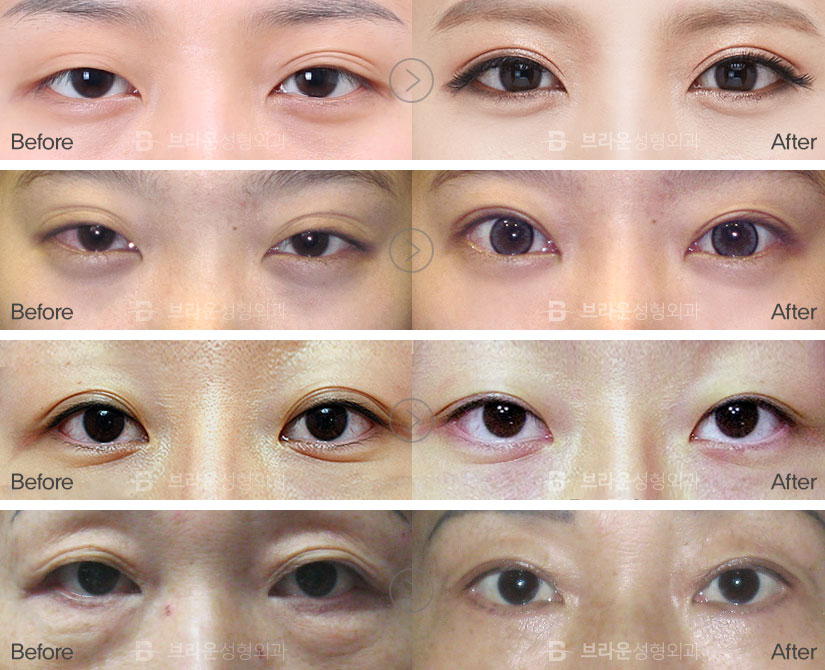 double eyelid surgery recovery process