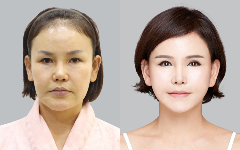 Time Returning Anti-Aging｜Braun Plastic Surgery