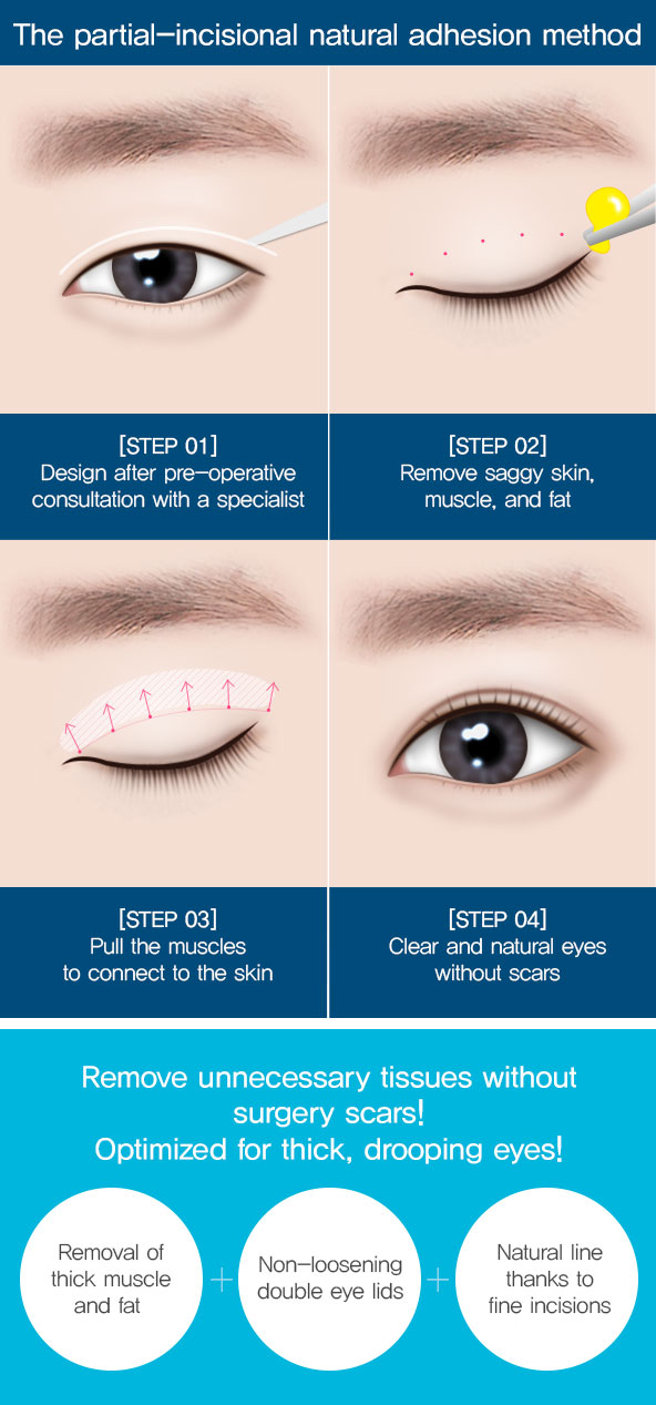 double eyelid incision method