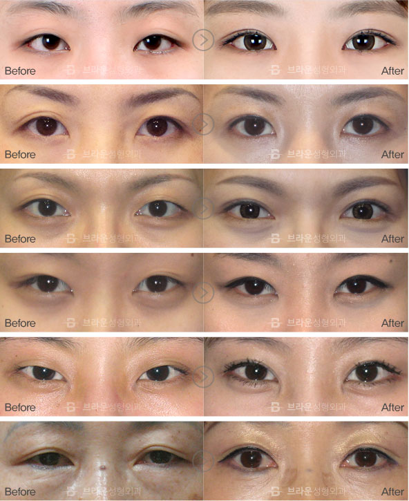 double eyelid surgery methods