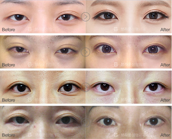 double eyelid operation