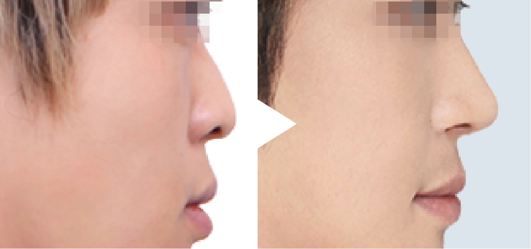 男性の鼻整形 Braun Plastic Surgery