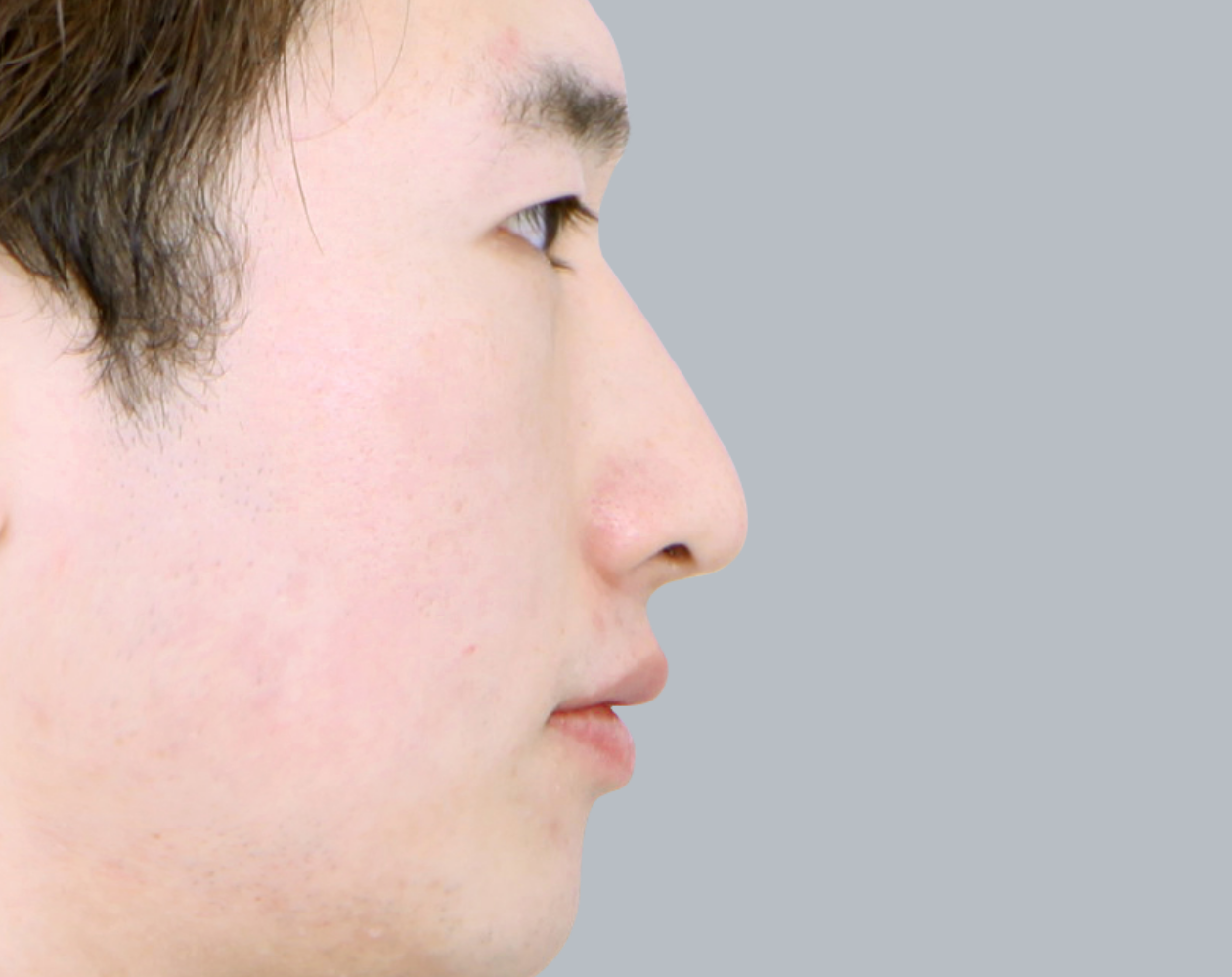 男性の鼻整形 Braun Plastic Surgery