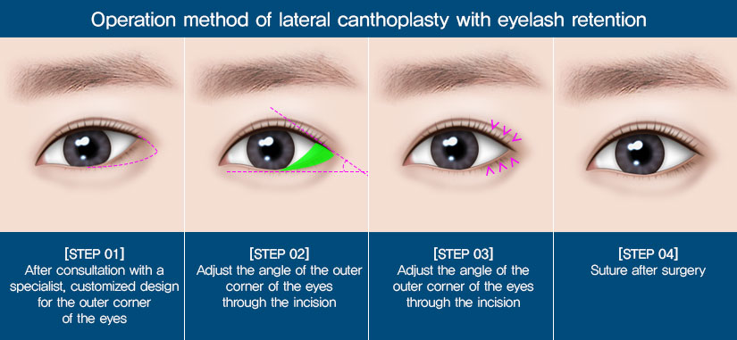 eye enlargement surgery caucasian