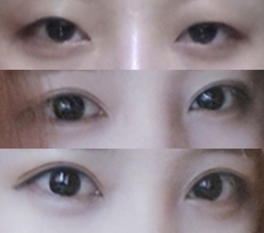 korean eyes before and after
