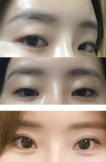 Hidden on sale double eyelid