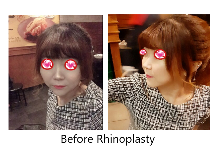 Real Selfi| BEST Plastic surgery in korea, Braun Plastic Surgery