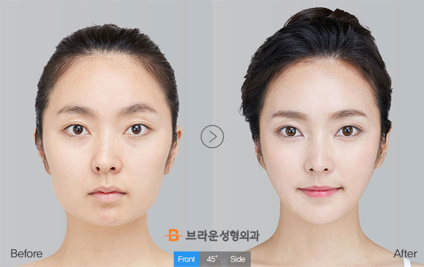 Facial Contour, V-Line Square Jaw Surgery | Braun Plastic Surgery